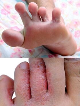 Foot fungus
