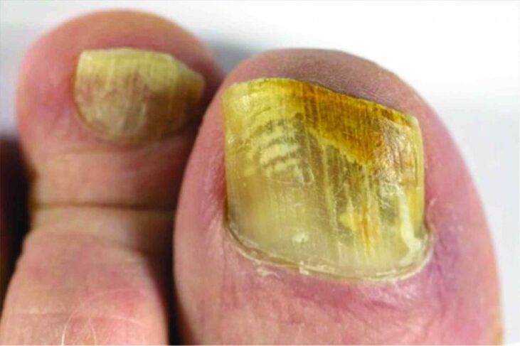 Feeling of nail on foot
