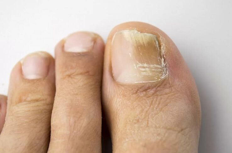 Myth of the nail in the legs