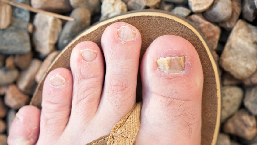 Onycomycosis of the nails